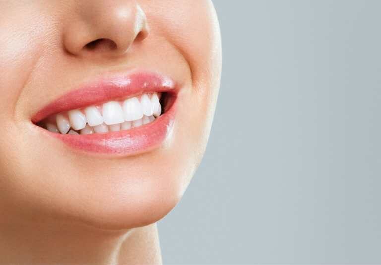 Teeth Whitening (San Ramon Only)